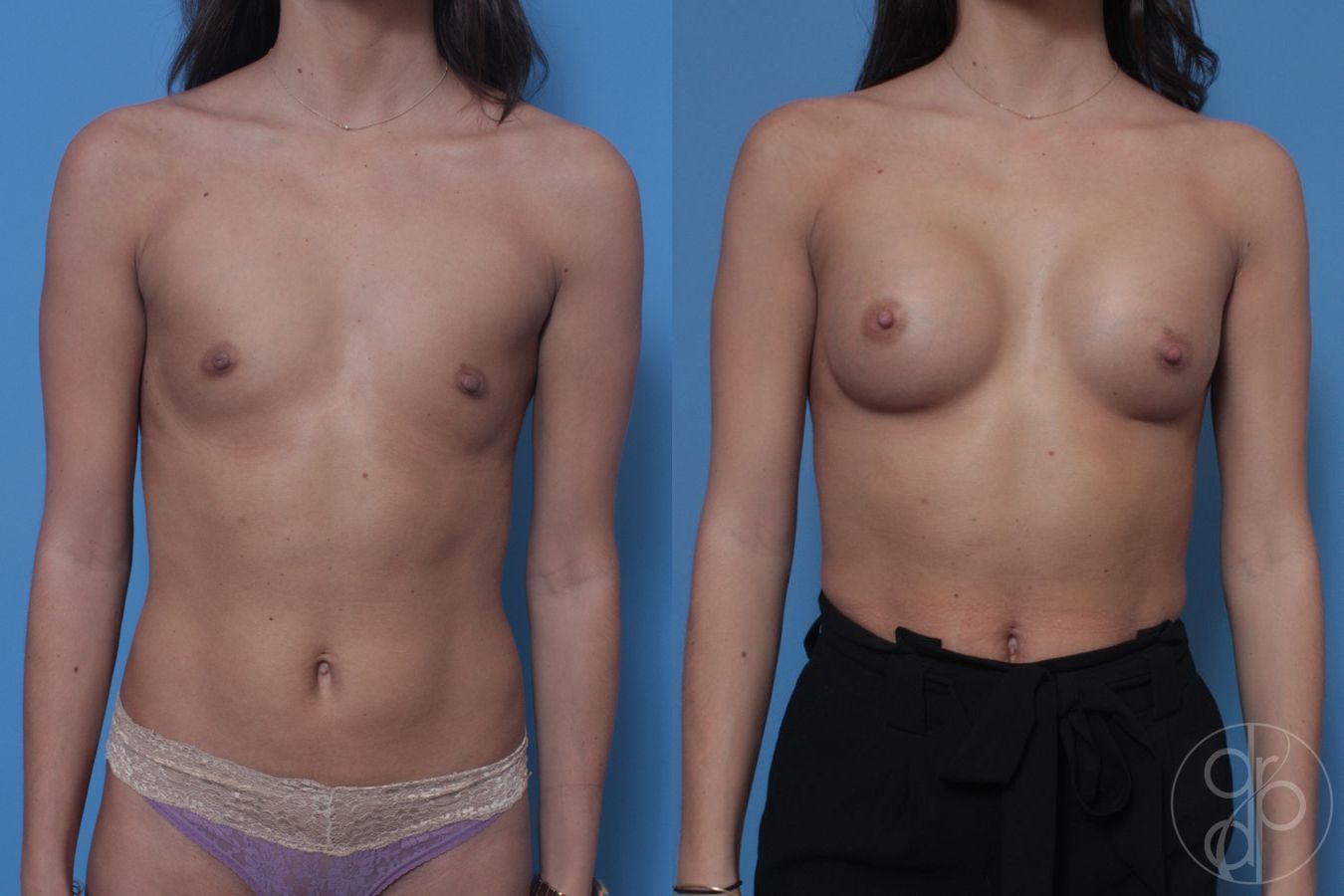 Breast Augmentation - Case 410