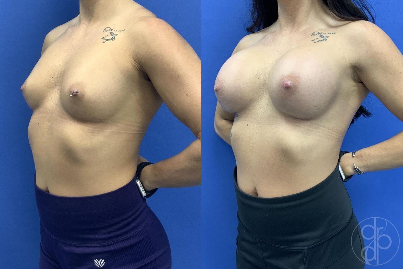 Before and after Breast Augmentation case 29606 - Angle 4