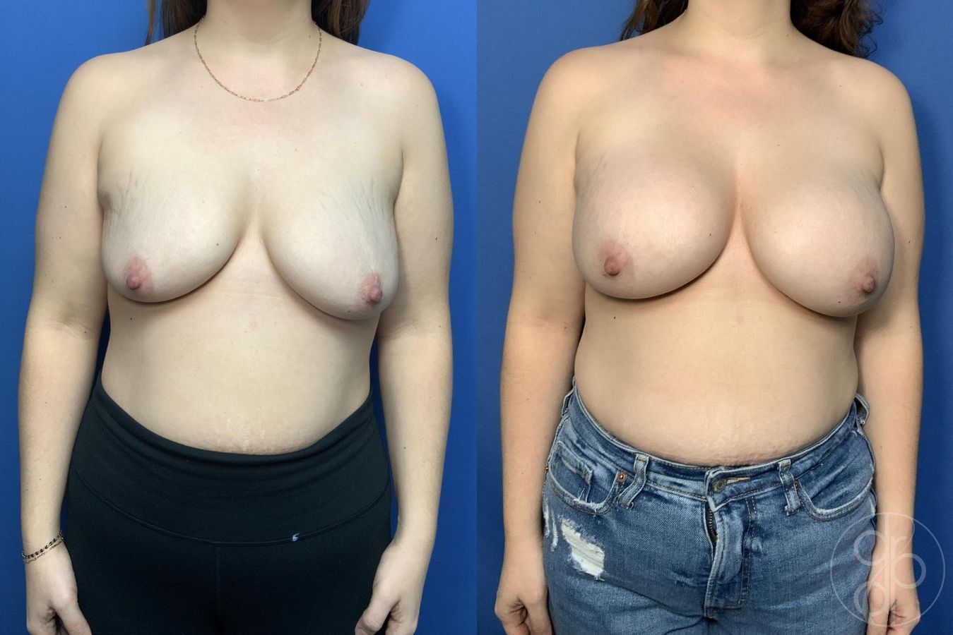 Before and after Breast Augmentation case 29989