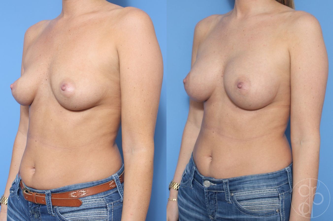 Before and after Breast Augmentation case 29919 - Angle 3