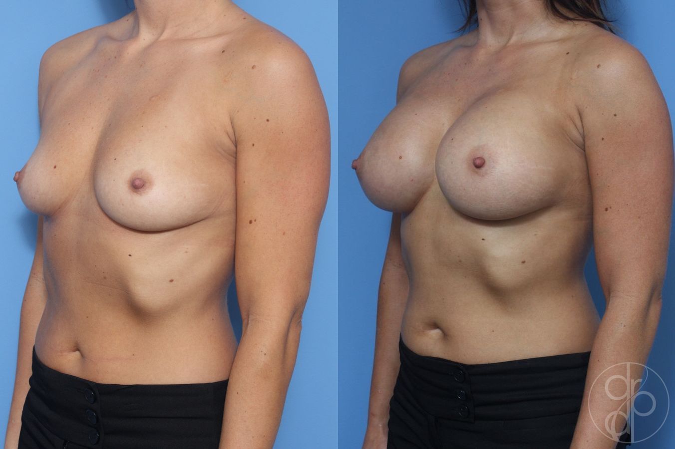Breast Augmentation - Thumbnail 2
