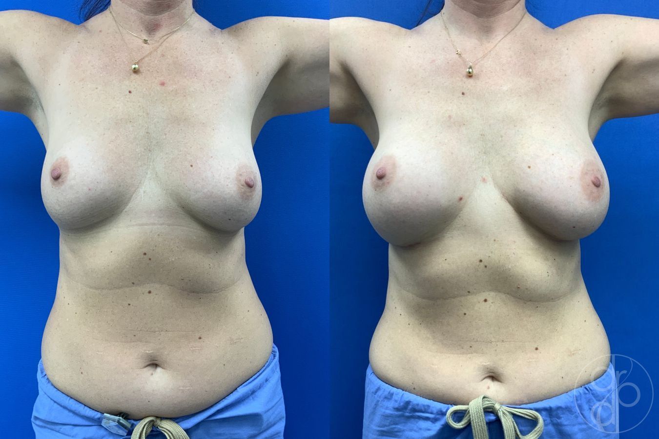 Before and after Breast Augmentation case 43190 - Angle 2