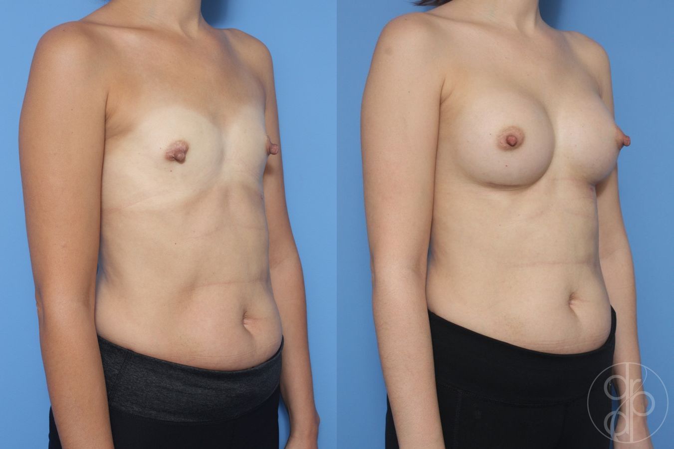 Before and after Breast Augmentation case 29952 - Angle 2