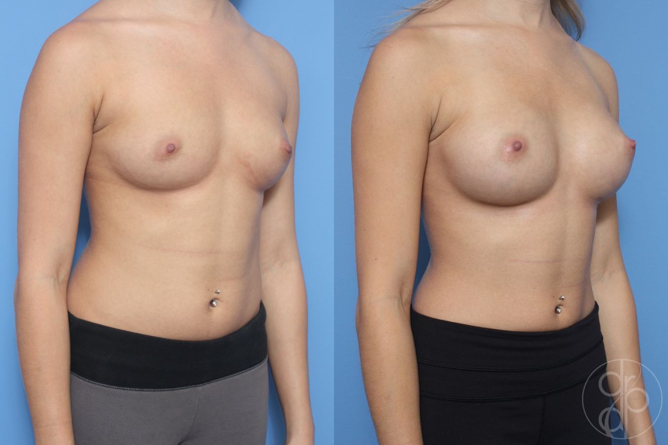 Before and after Breast Augmentation case 29908 - Angle 2