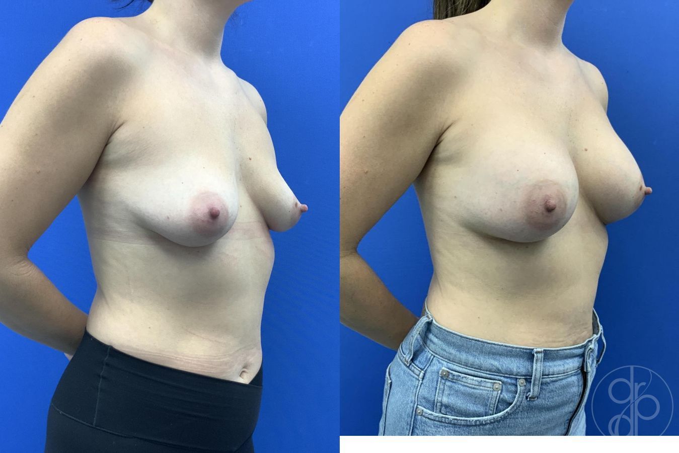 Before and after Breast Augmentation case 29655 - Angle 4