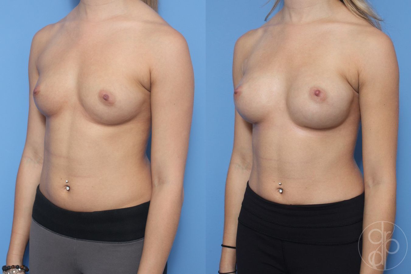 Before and after Breast Augmentation case 29908 - Angle 3