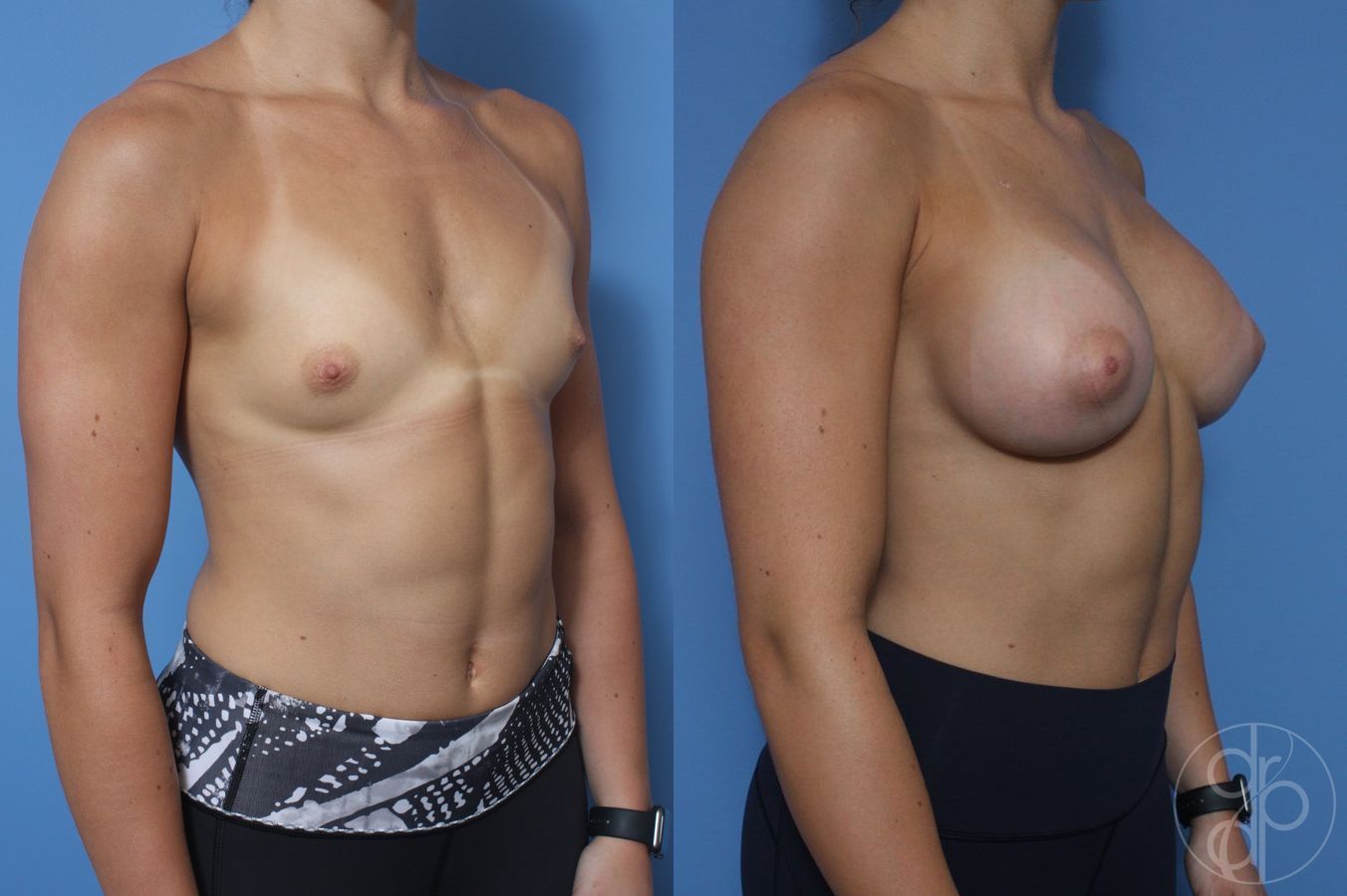Before and after Breast Augmentation case 29831 - Angle 2
