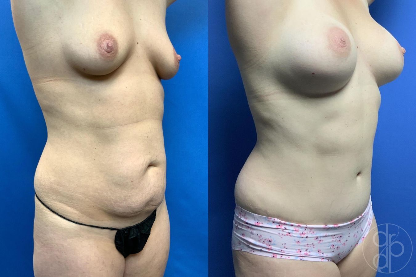 Before and after Mommy Makeover case 29728 - Angle 3