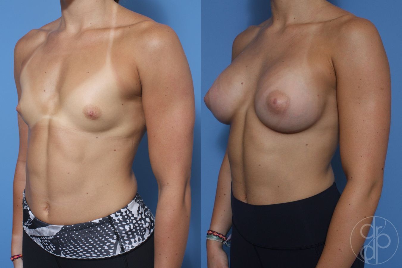 Before and after Breast Augmentation case 29831 - Angle 3