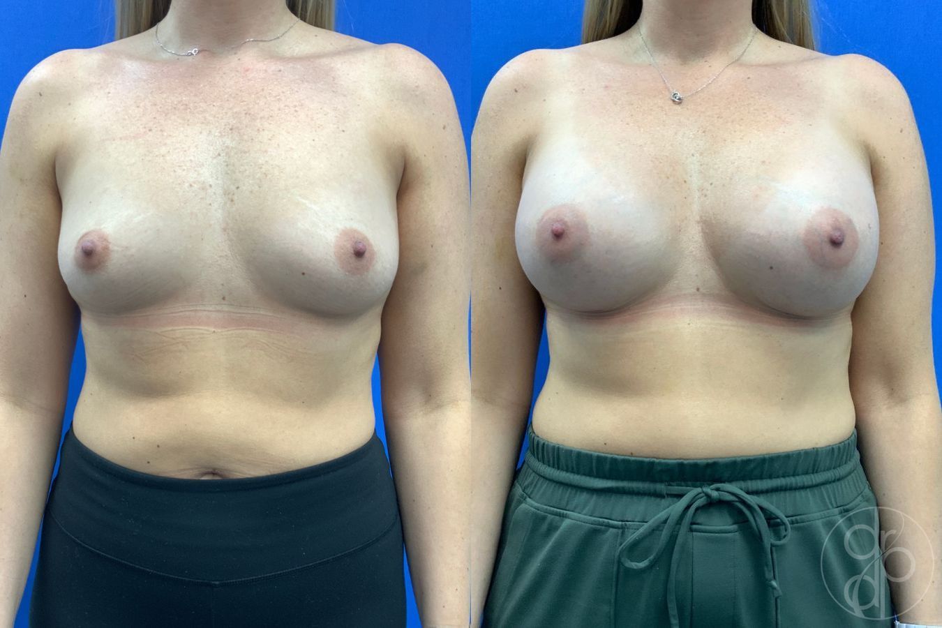 Before and after Breast Augmentation case 43197