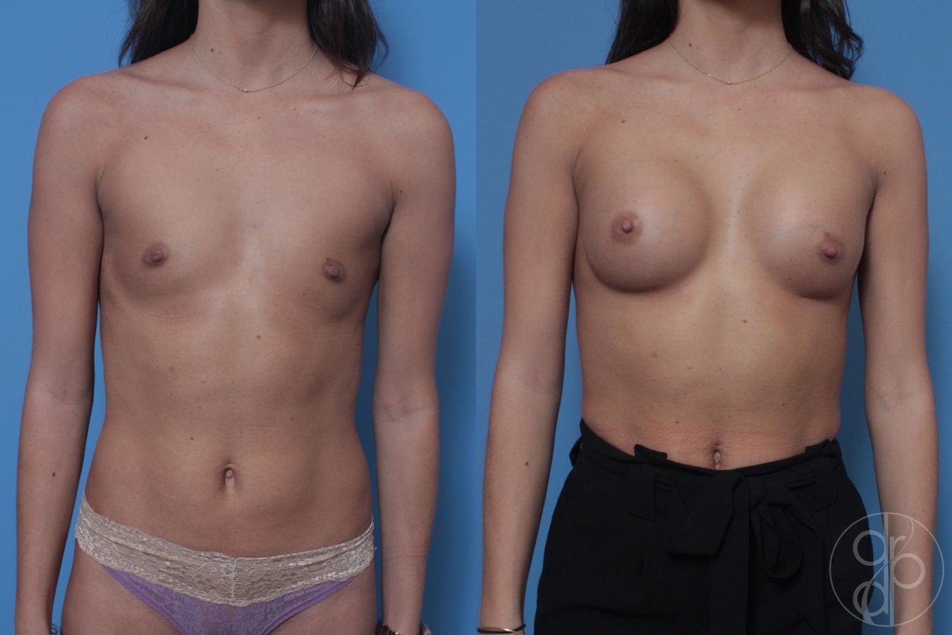 Before and after Breast Augmentation case 29924