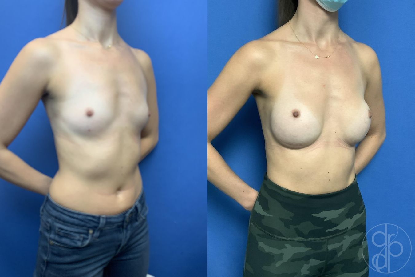 Breast Augmentation - Thumbnail 2
