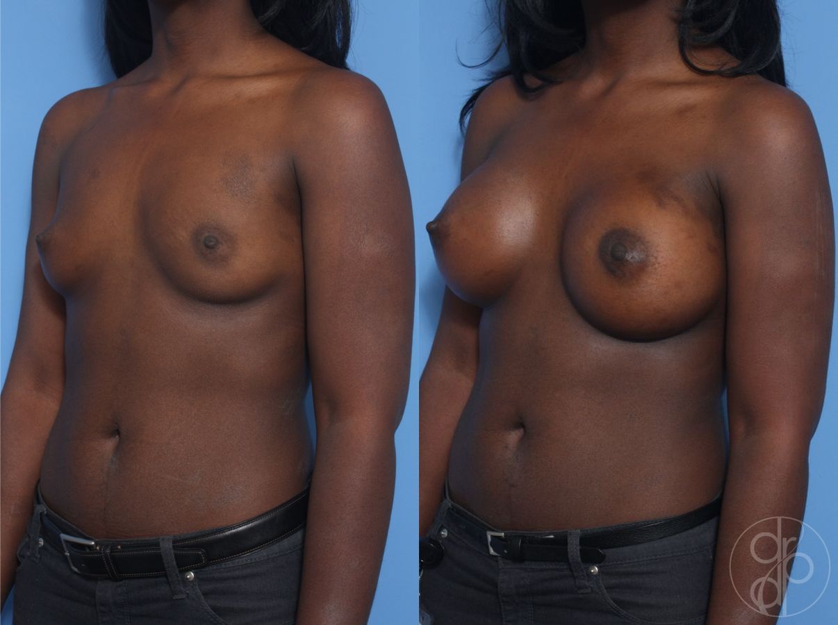Before and after Breast Augmentation case 29894 - Angle 3