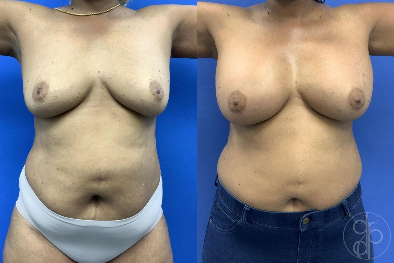 Before and after Breast Augmentation case 30026 - Angle 2