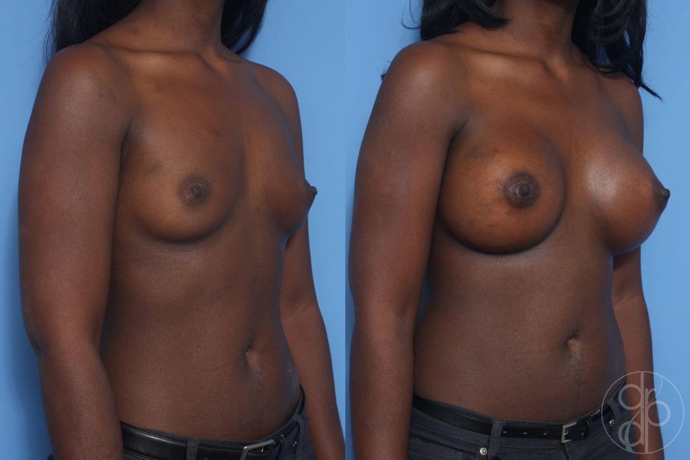 Before and after Breast Augmentation case 29894 - Angle 2