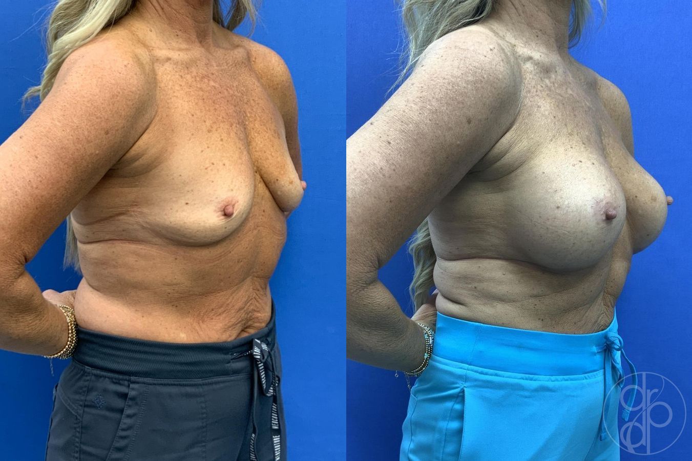 Breast Augmentation - Thumbnail 4