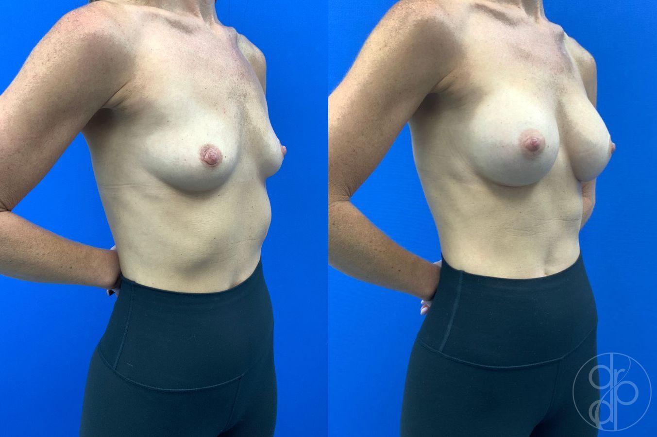 Before and after Breast Augmentation case 46252 - Angle 4