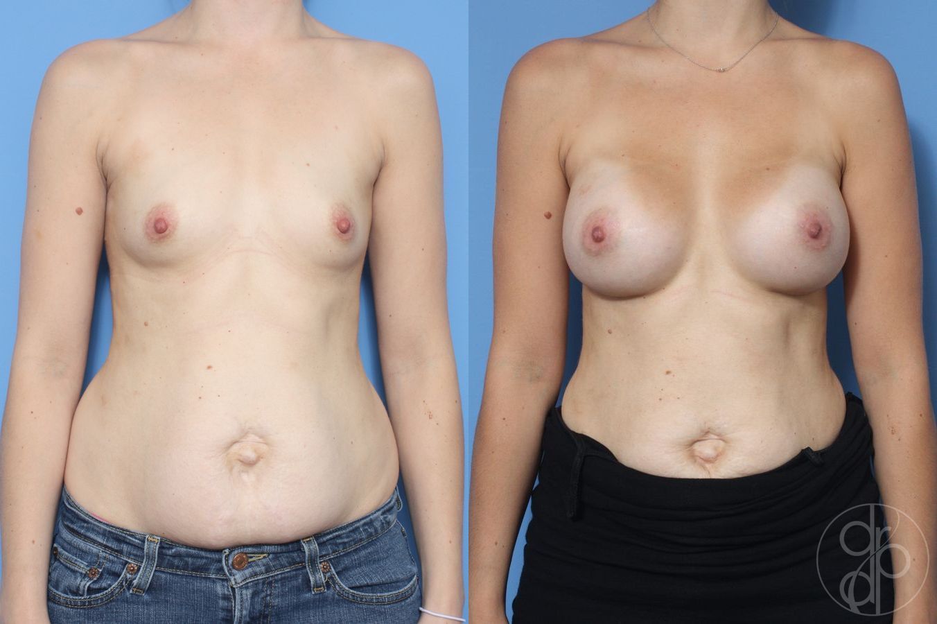 Before and after Breast Augmentation case 29961