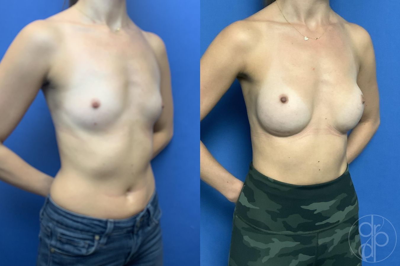 Before and after Breast Augmentation case 29788 - Angle 2