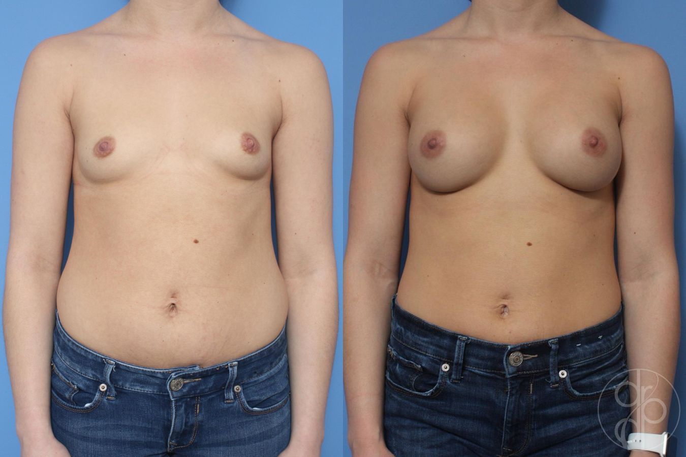 Before and after Breast Augmentation case 30005