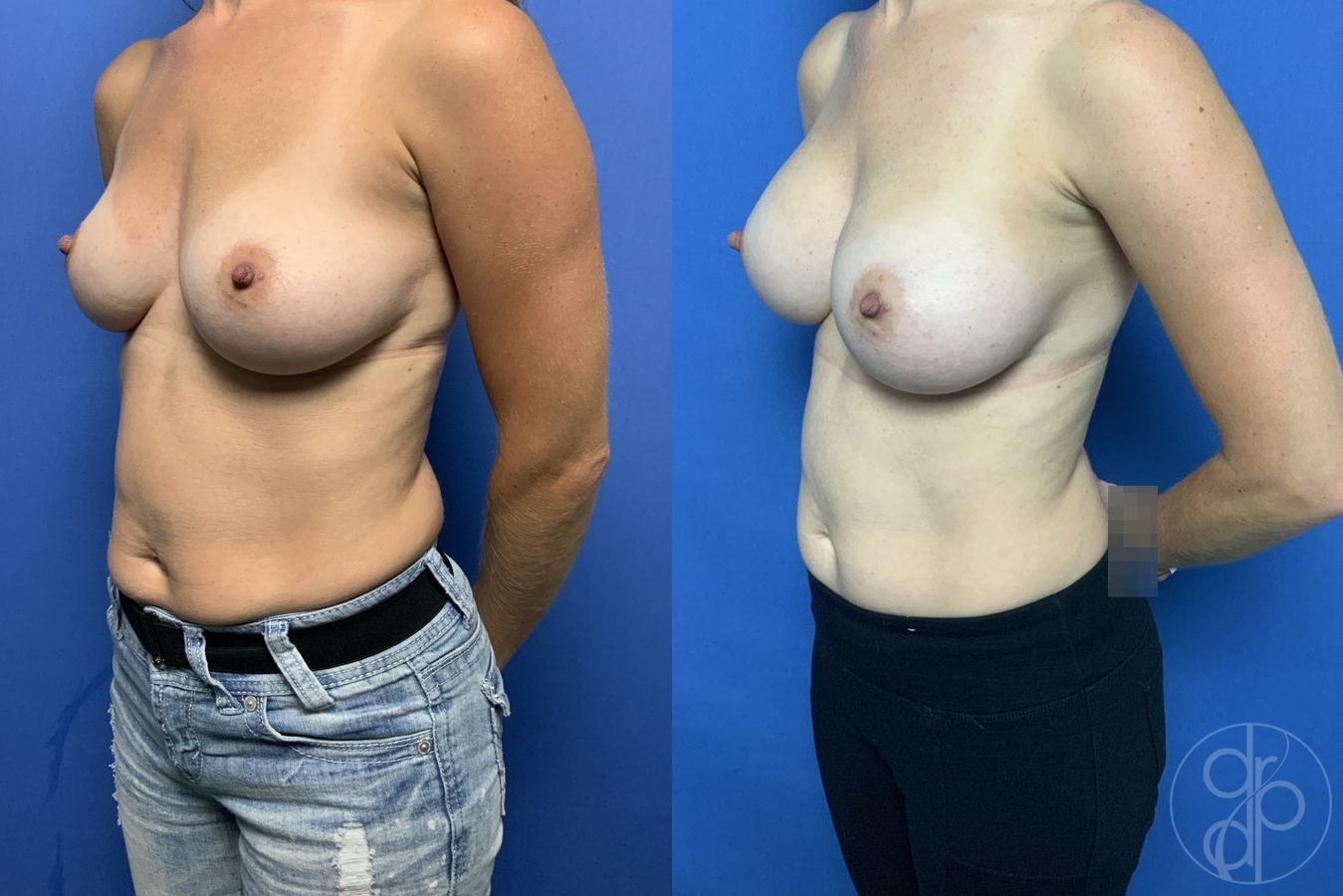 Before and after Breast Augmentation case 29830 - Angle 3