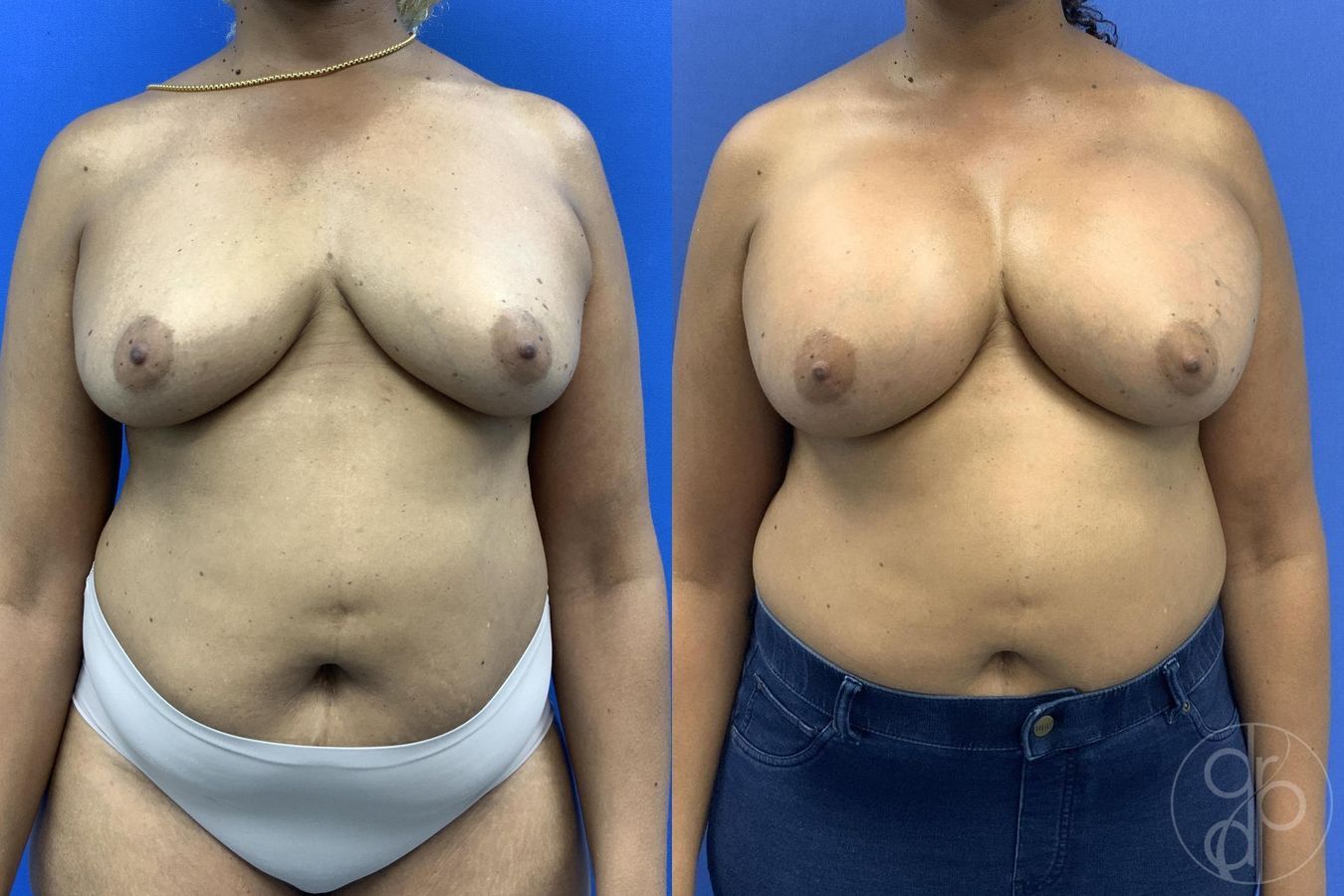Before and after Breast Augmentation case 30026