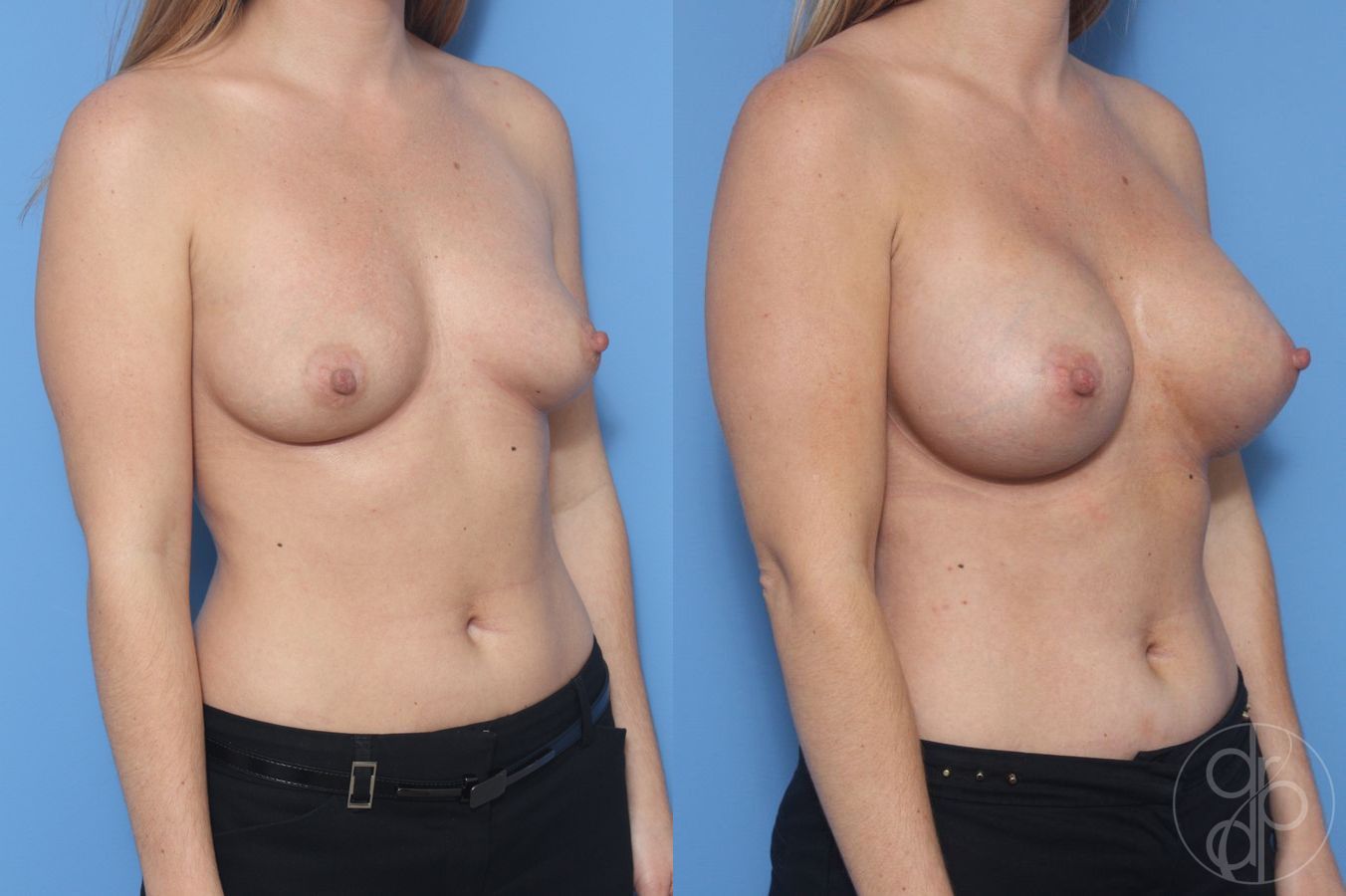 Before and after Breast Augmentation case 29962 - Angle 2