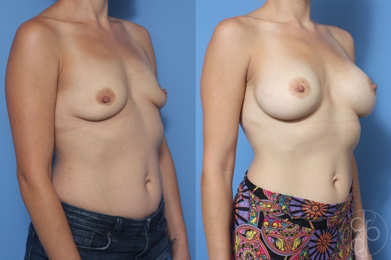 Before and after Breast Augmentation case 29926 - Angle 2