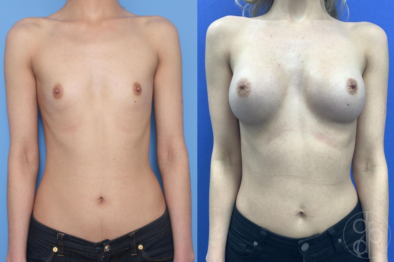 Before and after Breast Augmentation case 29935