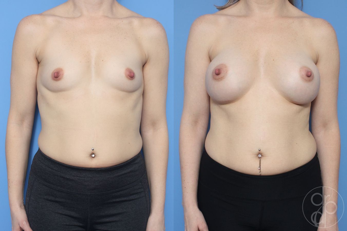 Before and after Breast Augmentation case 29927