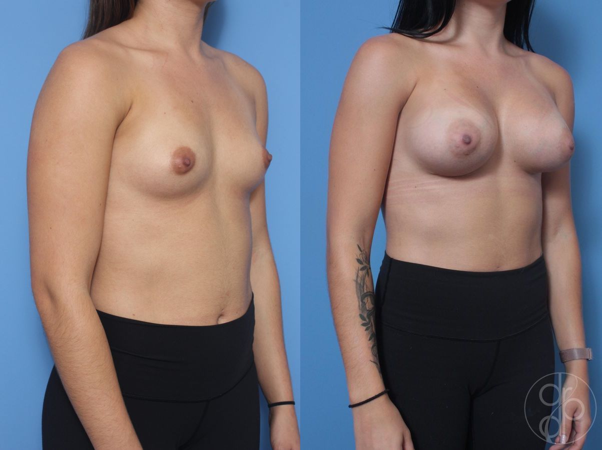 Before and after Breast Augmentation case 29819 - Angle 4