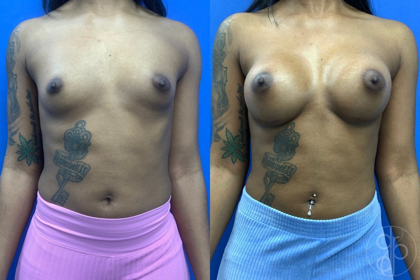Before and after Breast Augmentation case 43488
