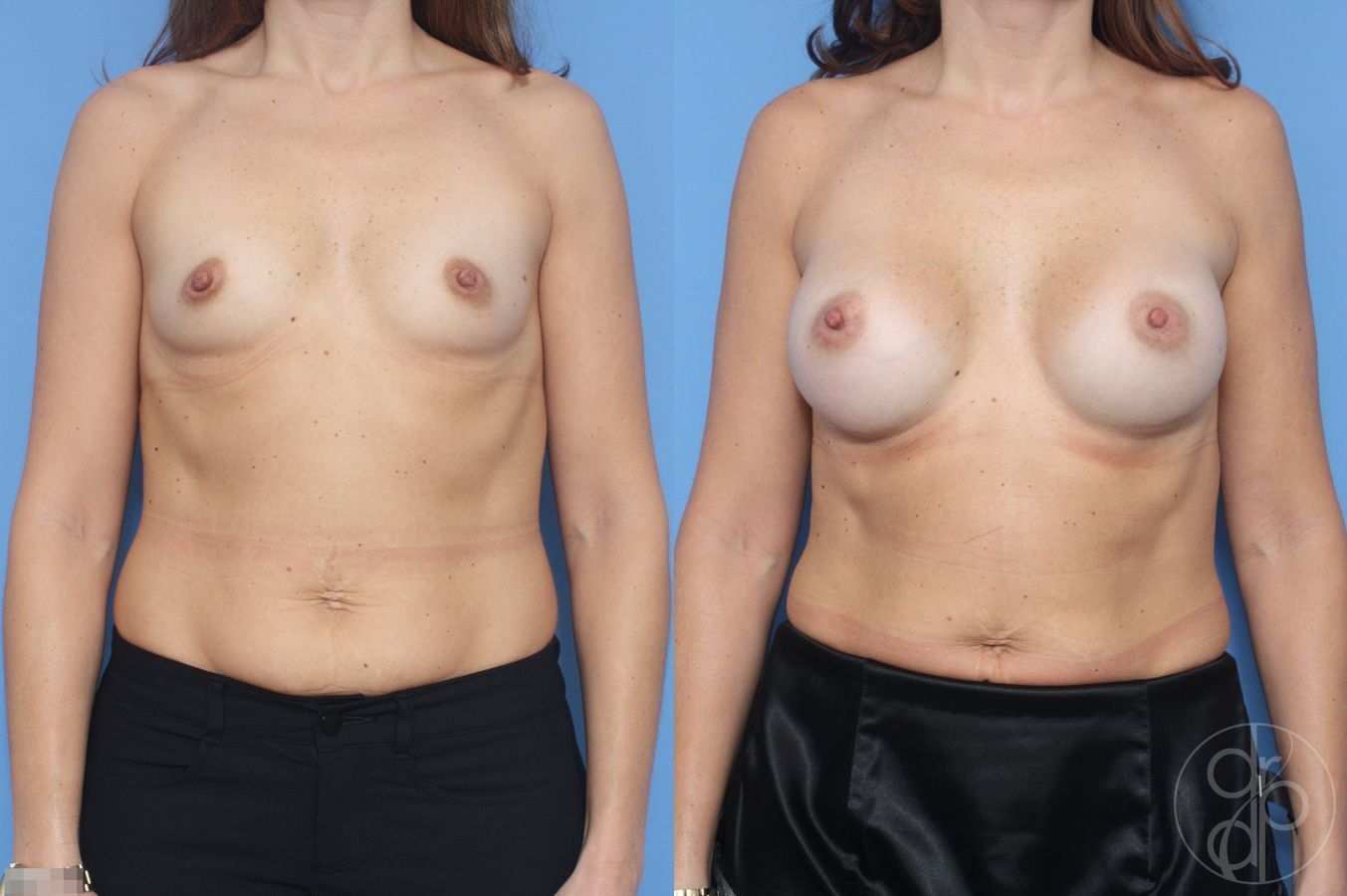 Before and after Breast Augmentation case 29928