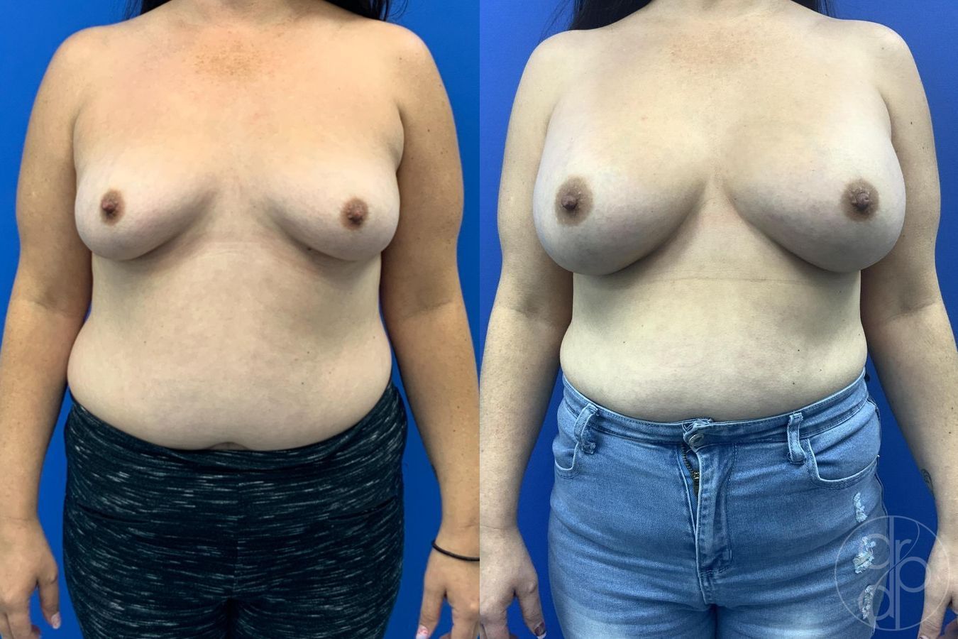 Before and after procedure result