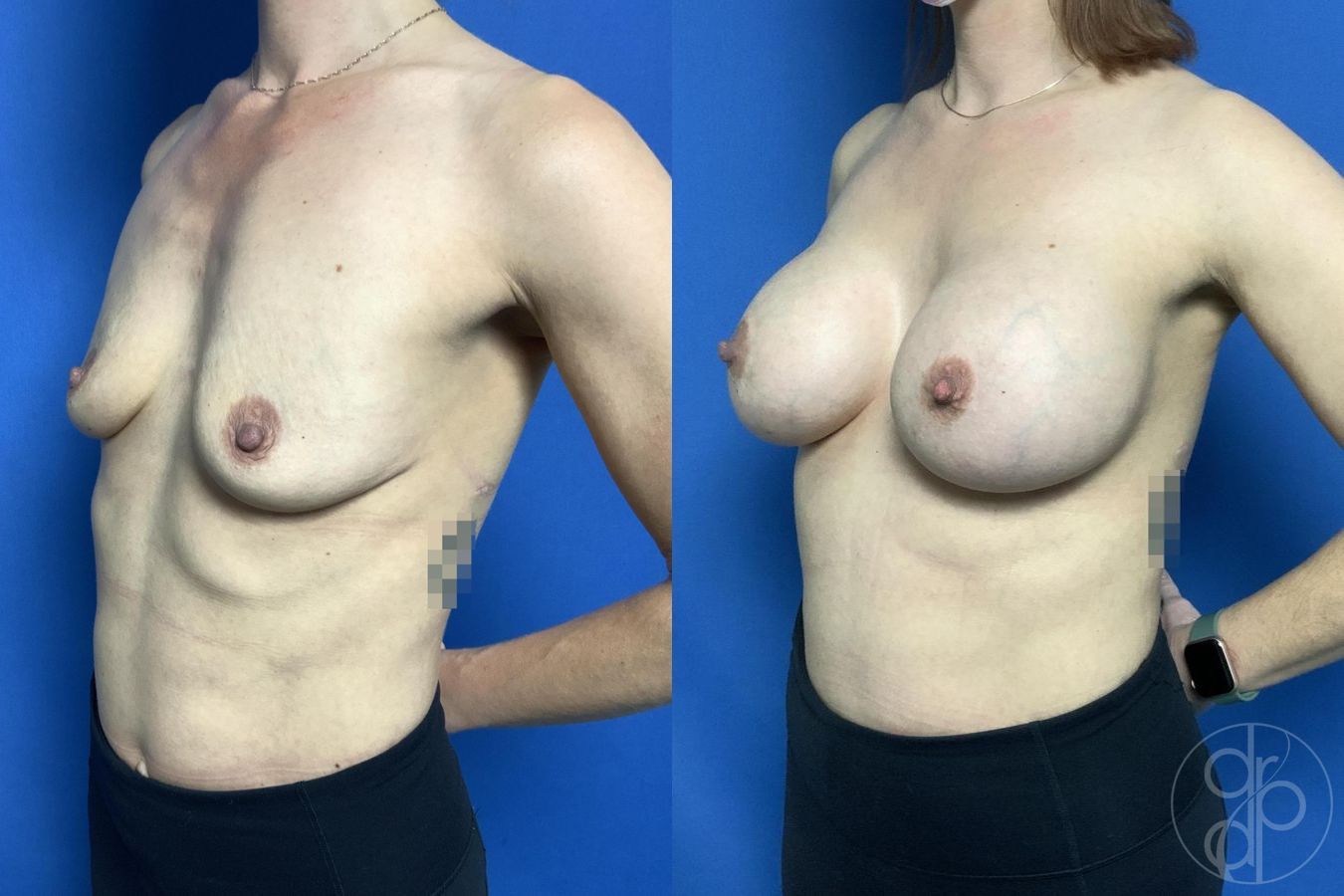Before and after Breast Augmentation case 29999 - Angle 3