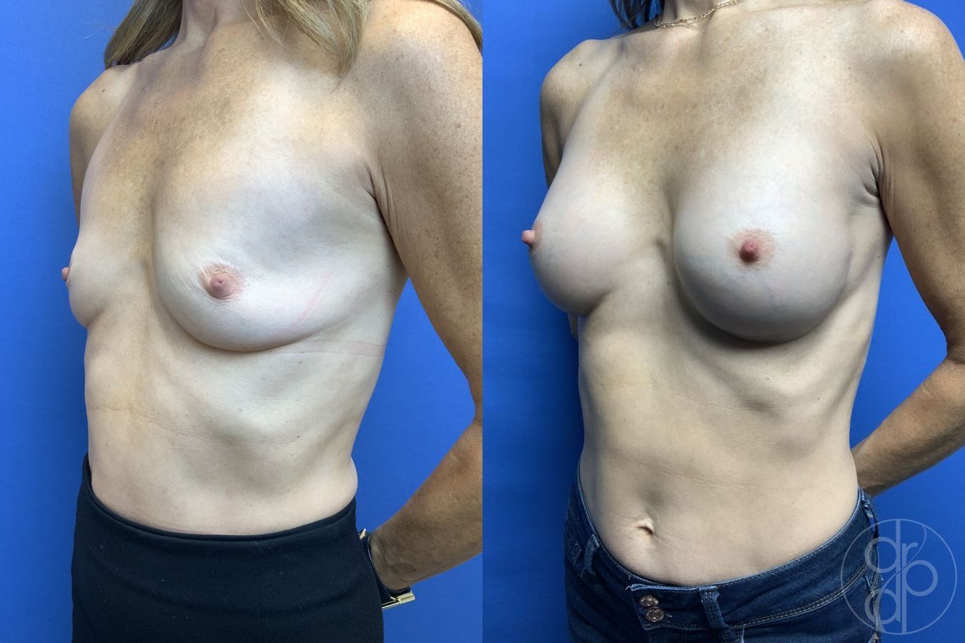 Before and after Breast Augmentation case 29923 - Angle 3
