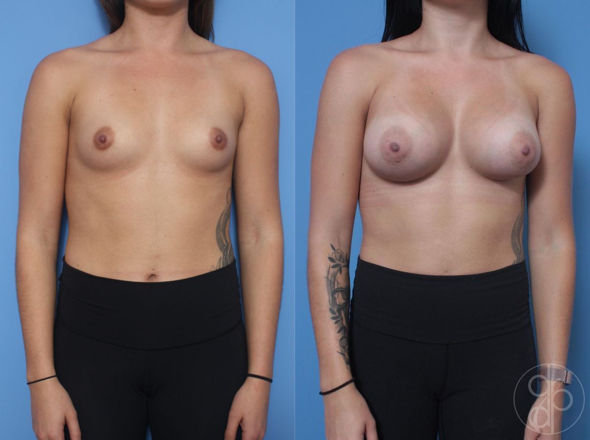 Before and after Breast Augmentation case 29819
