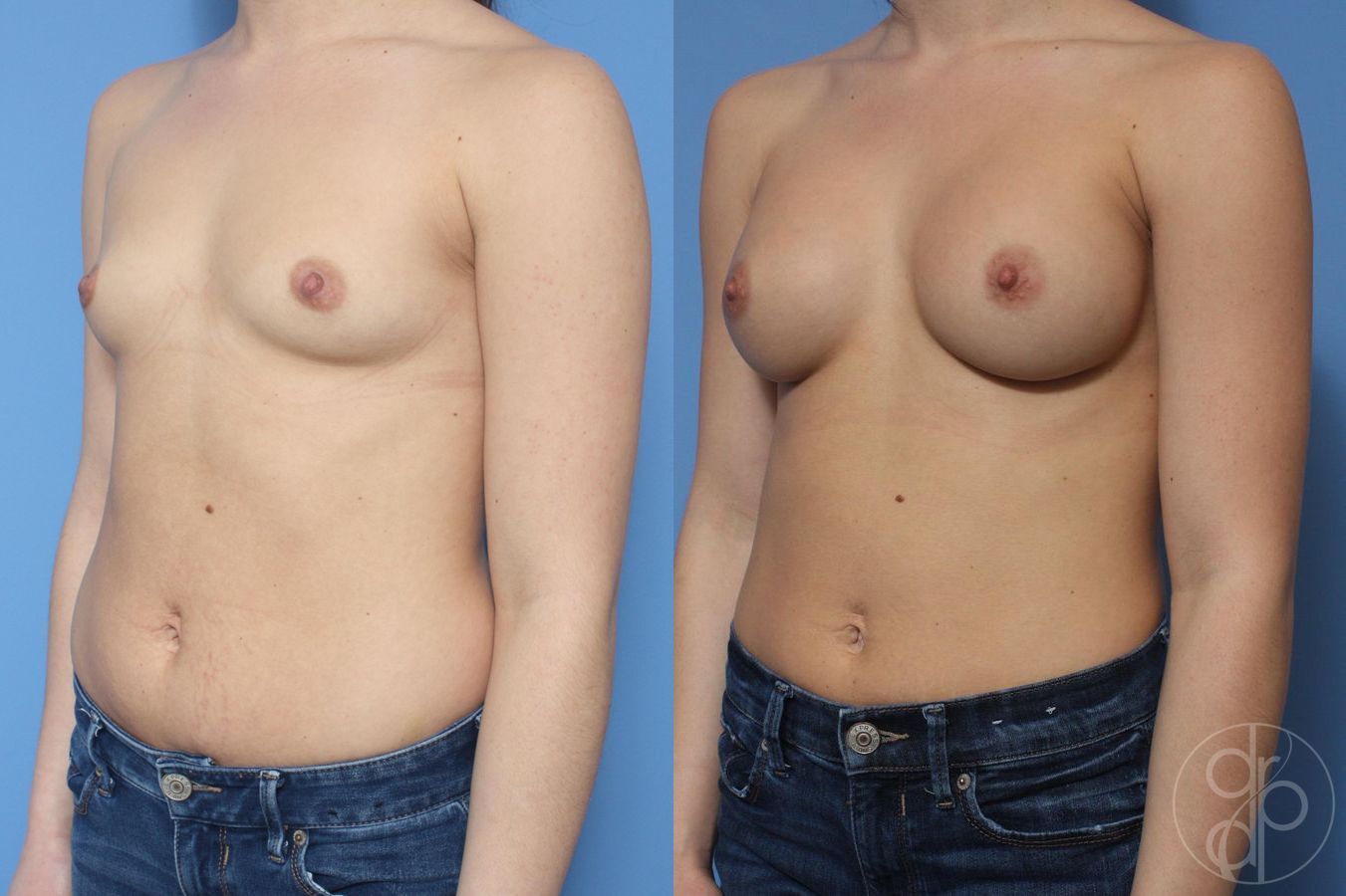 Breast Augmentation - Thumbnail 2