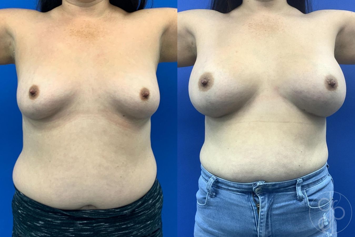 Before and after Breast Augmentation case 29611 - Angle 2