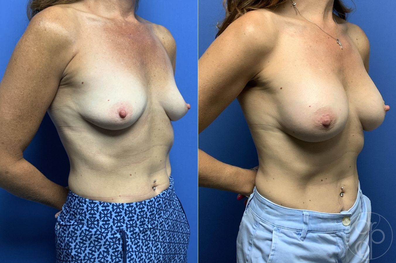 Before and after Breast Augmentation case 29792 - Angle 2