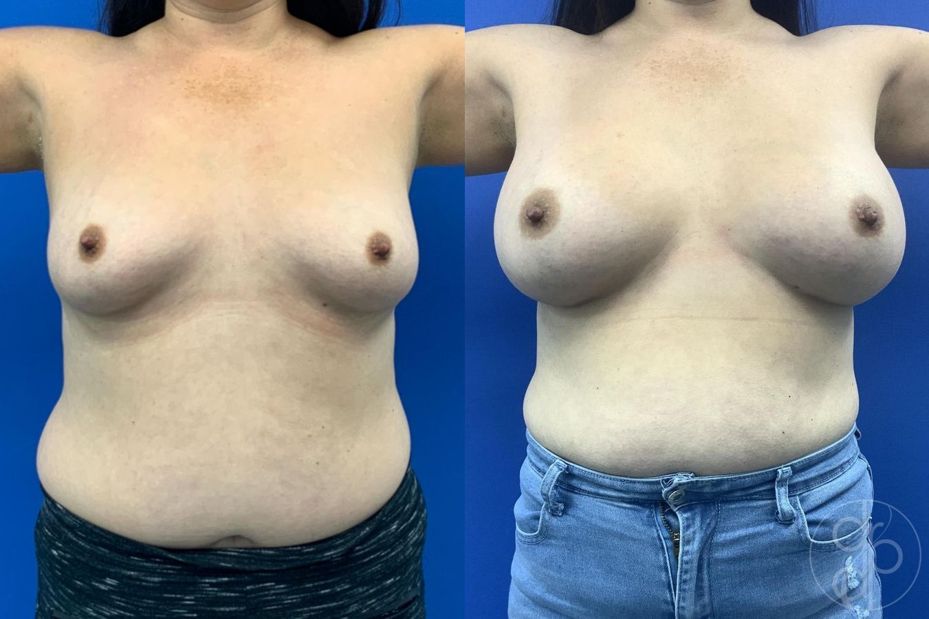 Before and after Breast Augmentation case 29611 - Angle 2