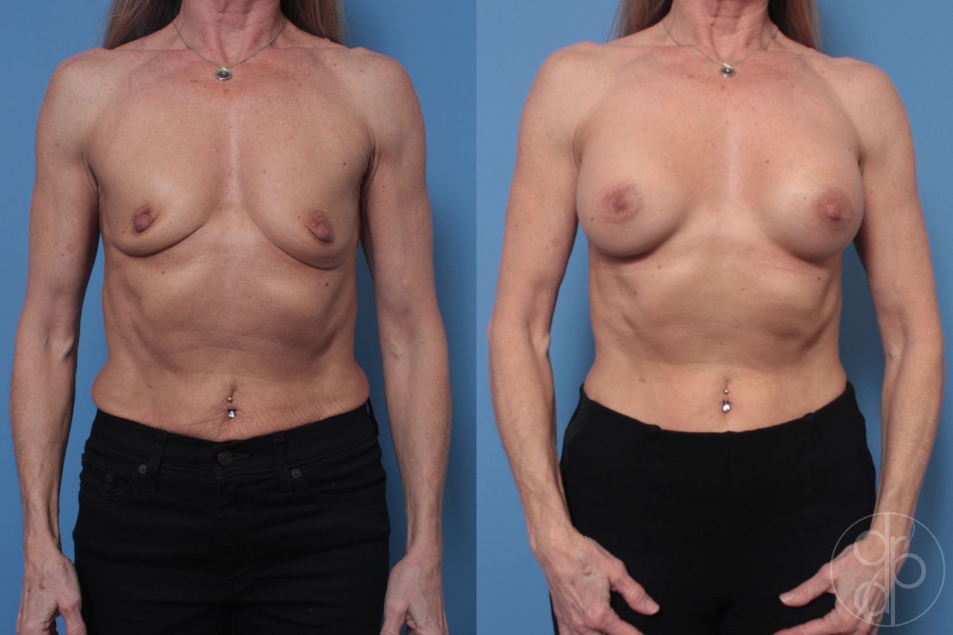 Breast Augmentation - Case 408