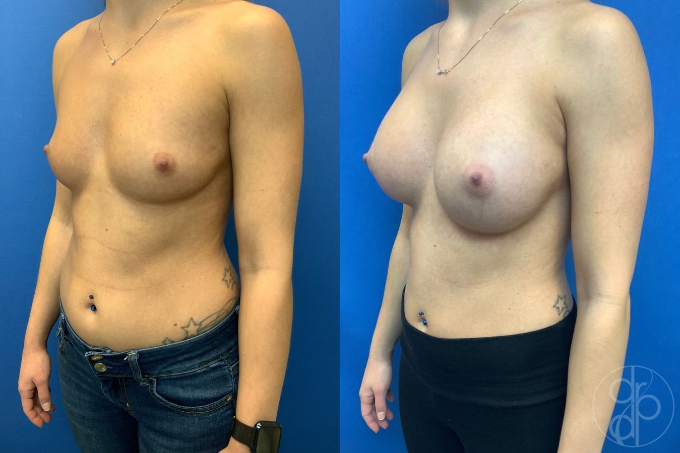 Before and after Breast Augmentation case 29943 - Angle 3