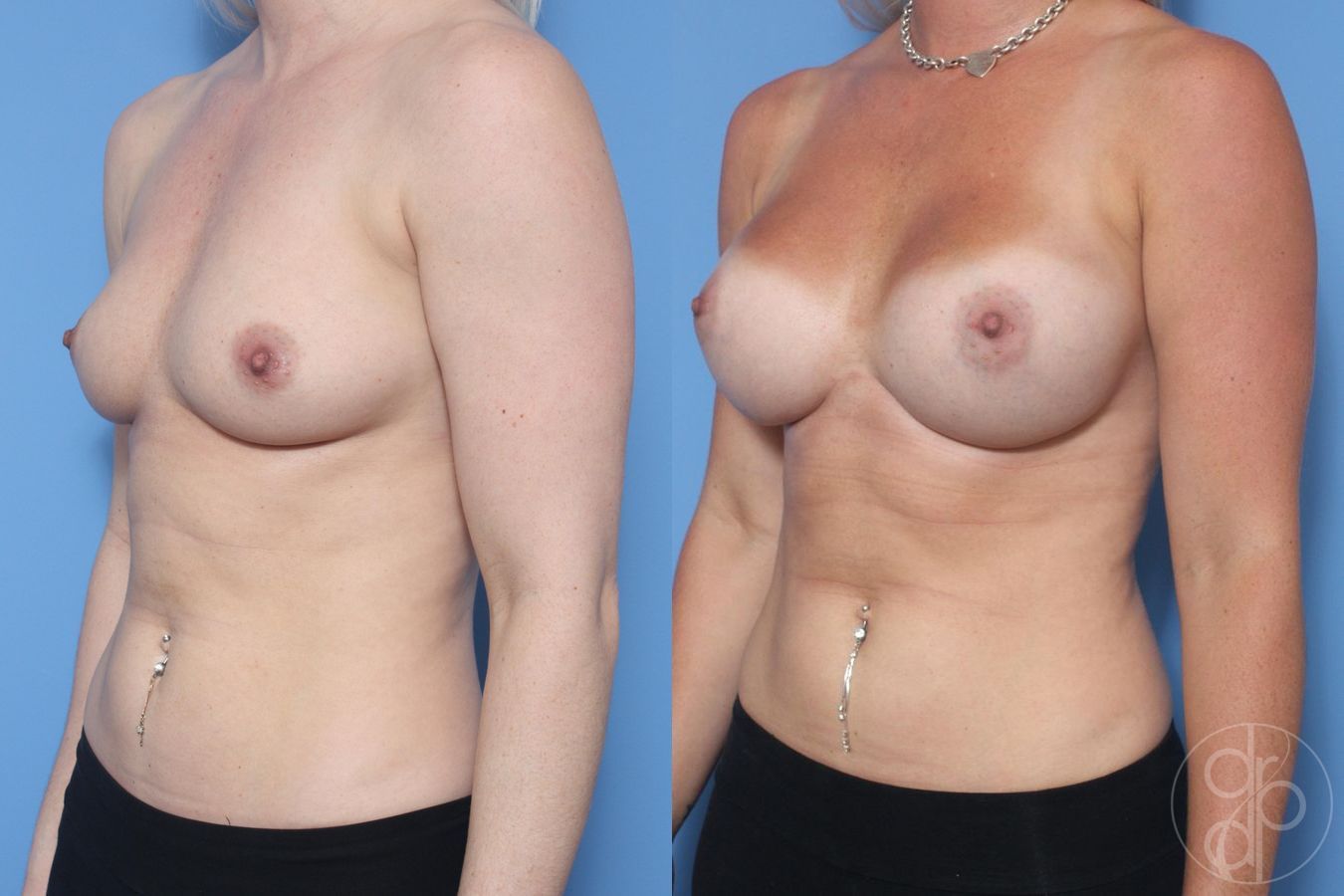 Before and after Breast Augmentation case 29616 - Angle 4