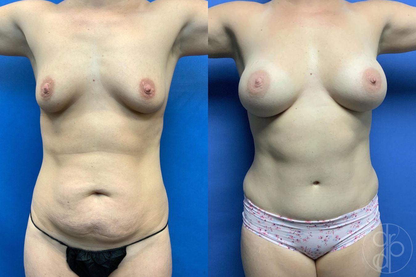 Before and after Mommy Makeover case 29728 - Angle 2