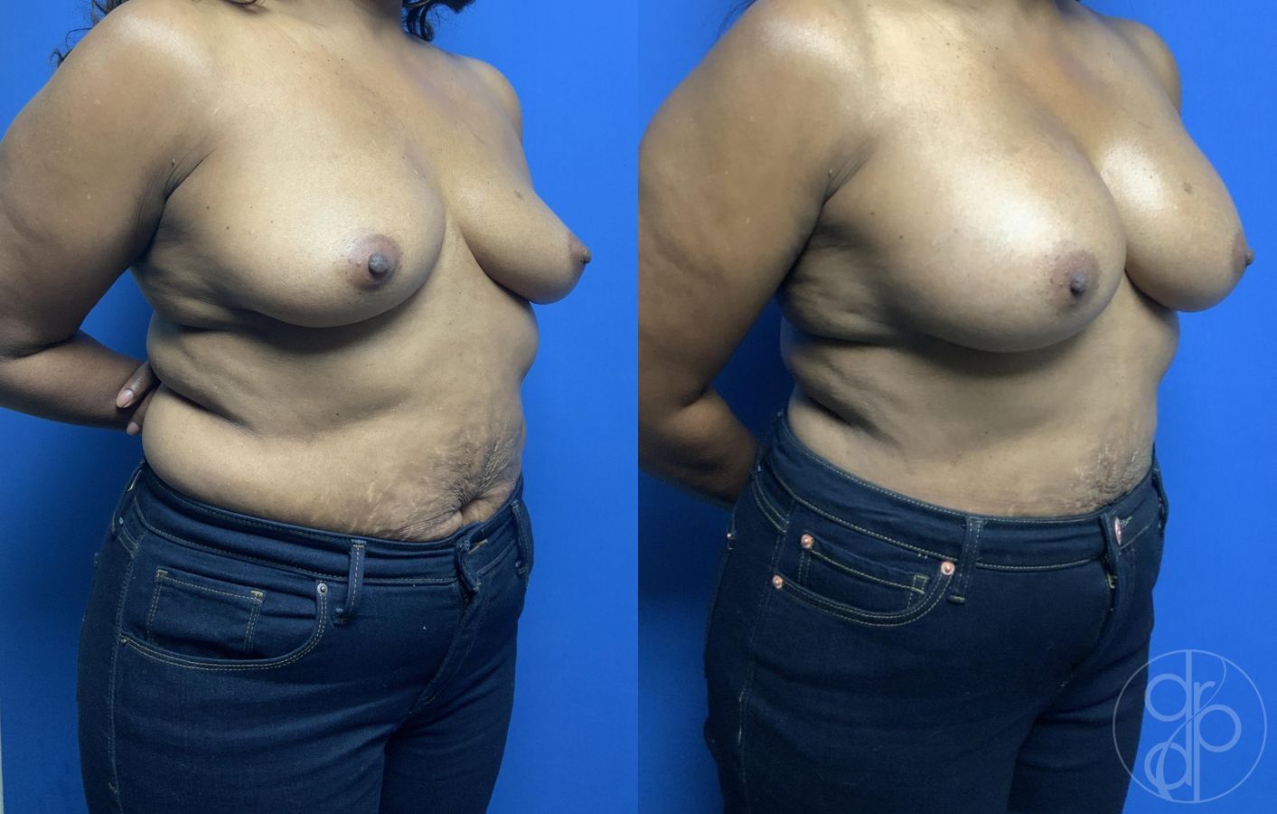 Before and after Breast Augmentation case 29786 - Angle 2