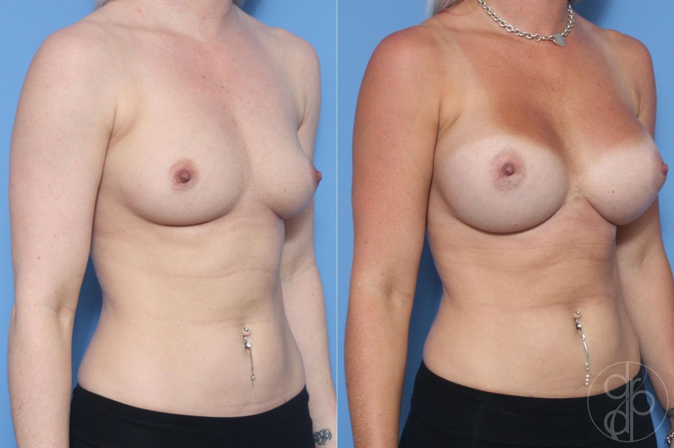 Before and after Breast Augmentation case 29616 - Angle 3