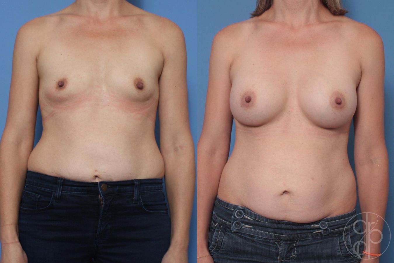 Before and after Breast Augmentation case 29644