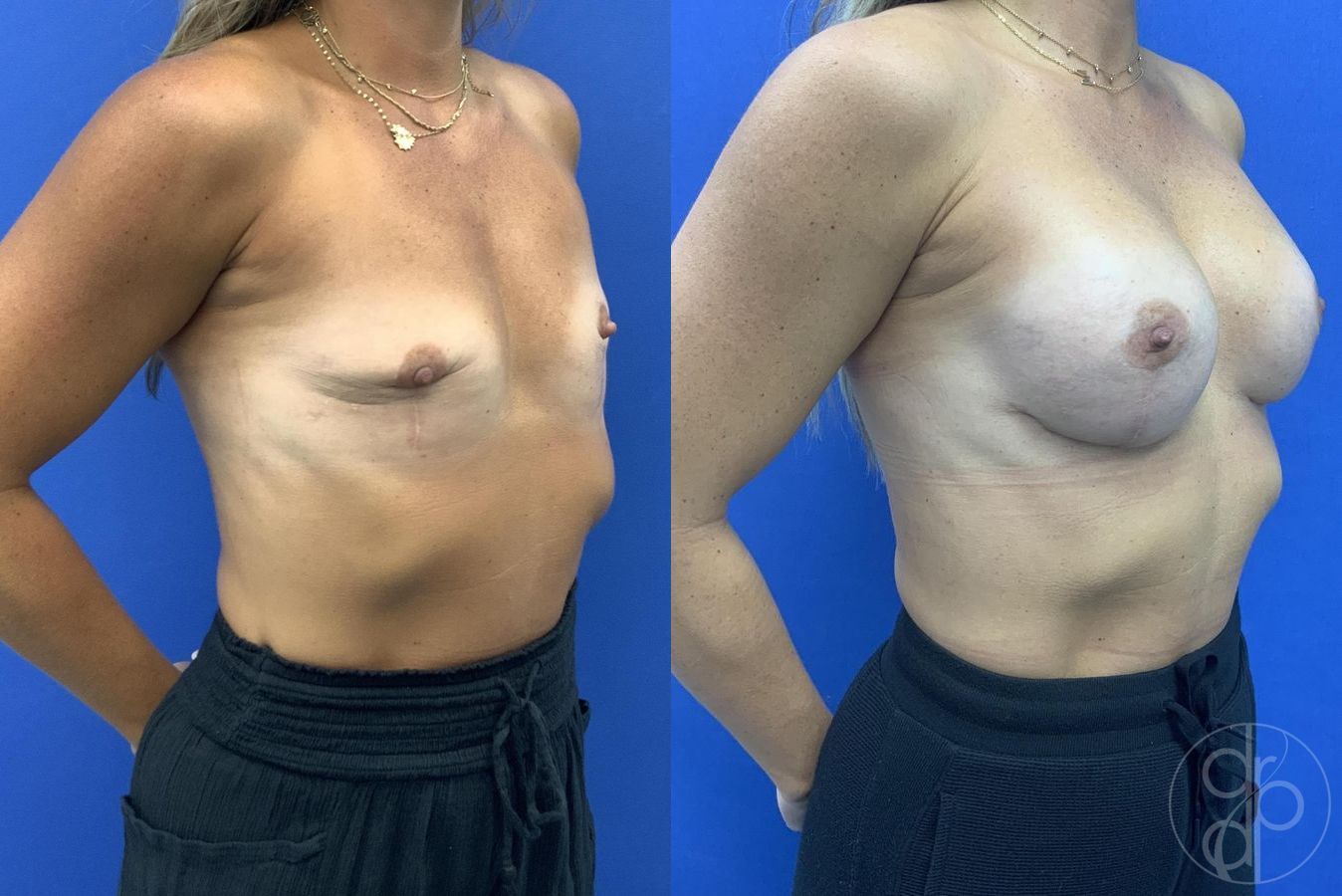Before and after Breast Augmentation case 29617 - Angle 3