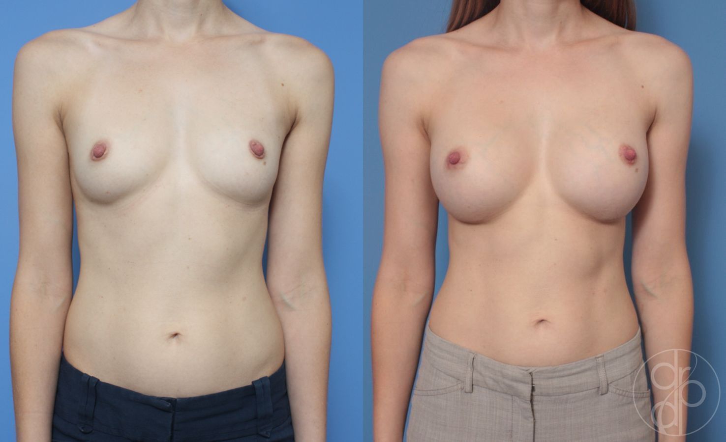 Before and after Breast Augmentation case 29909